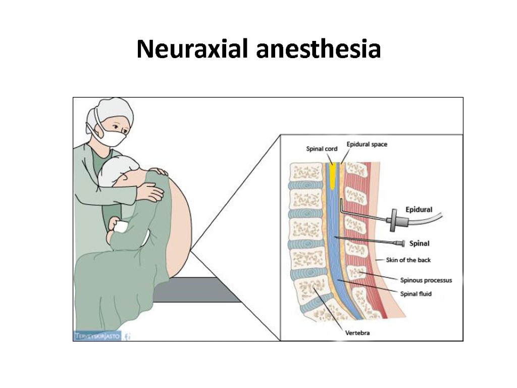 Neuraxial anesthesia